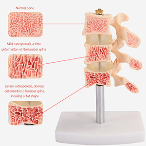 Typical spinal lesion Model